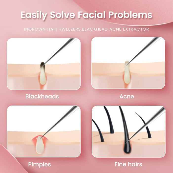 Ultra-Precision Blackhead Extractor: Advanced German Engineering for Radiant Skin